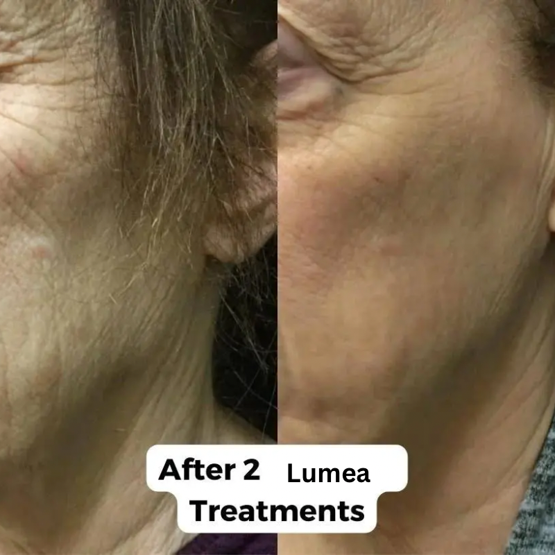 Lumea™ Micro-Infusion Wrinkle Renewal System