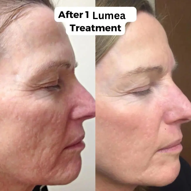 Lumea™ Micro-Infusion Wrinkle Renewal System
