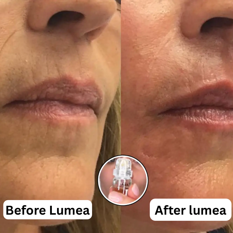 Lumea™ Micro-Infusion Wrinkle Renewal System