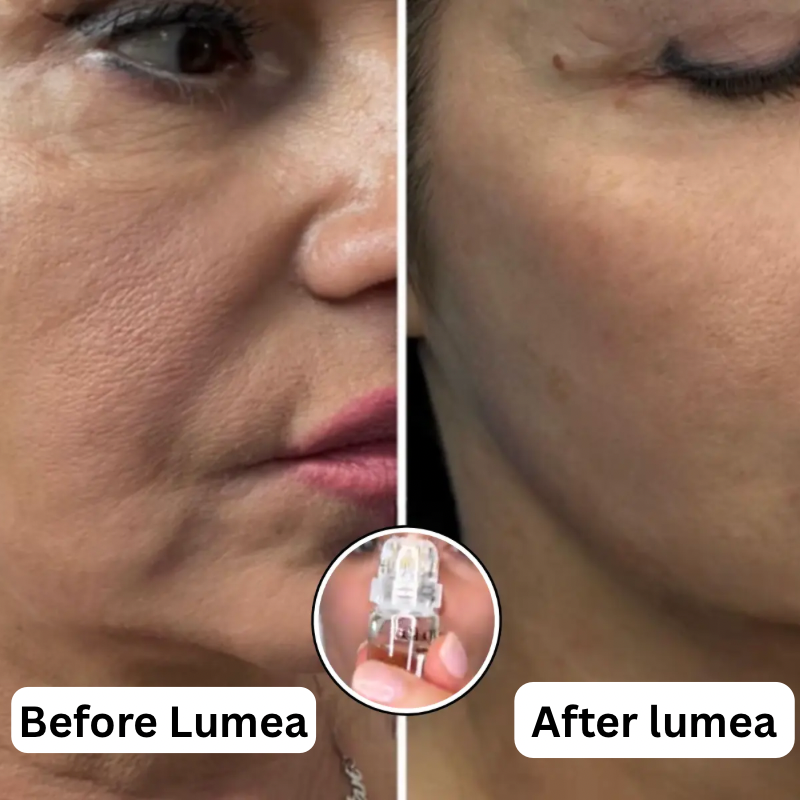 Lumea™ Micro-Infusion Wrinkle Renewal System