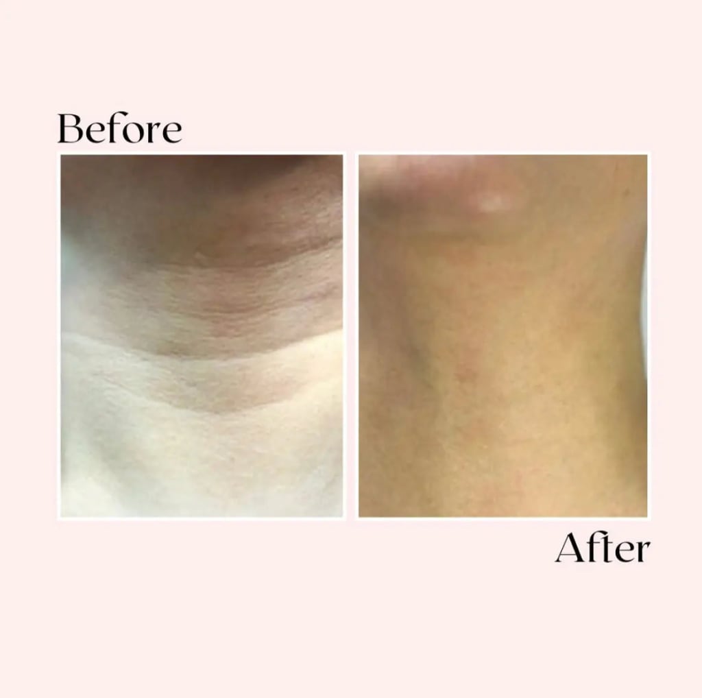 Lumea™ Micro-Infusion Wrinkle Renewal System